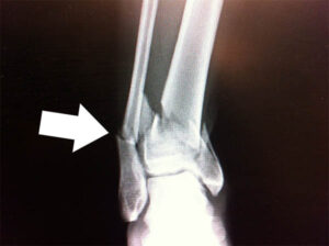 x-ray of broken joint
